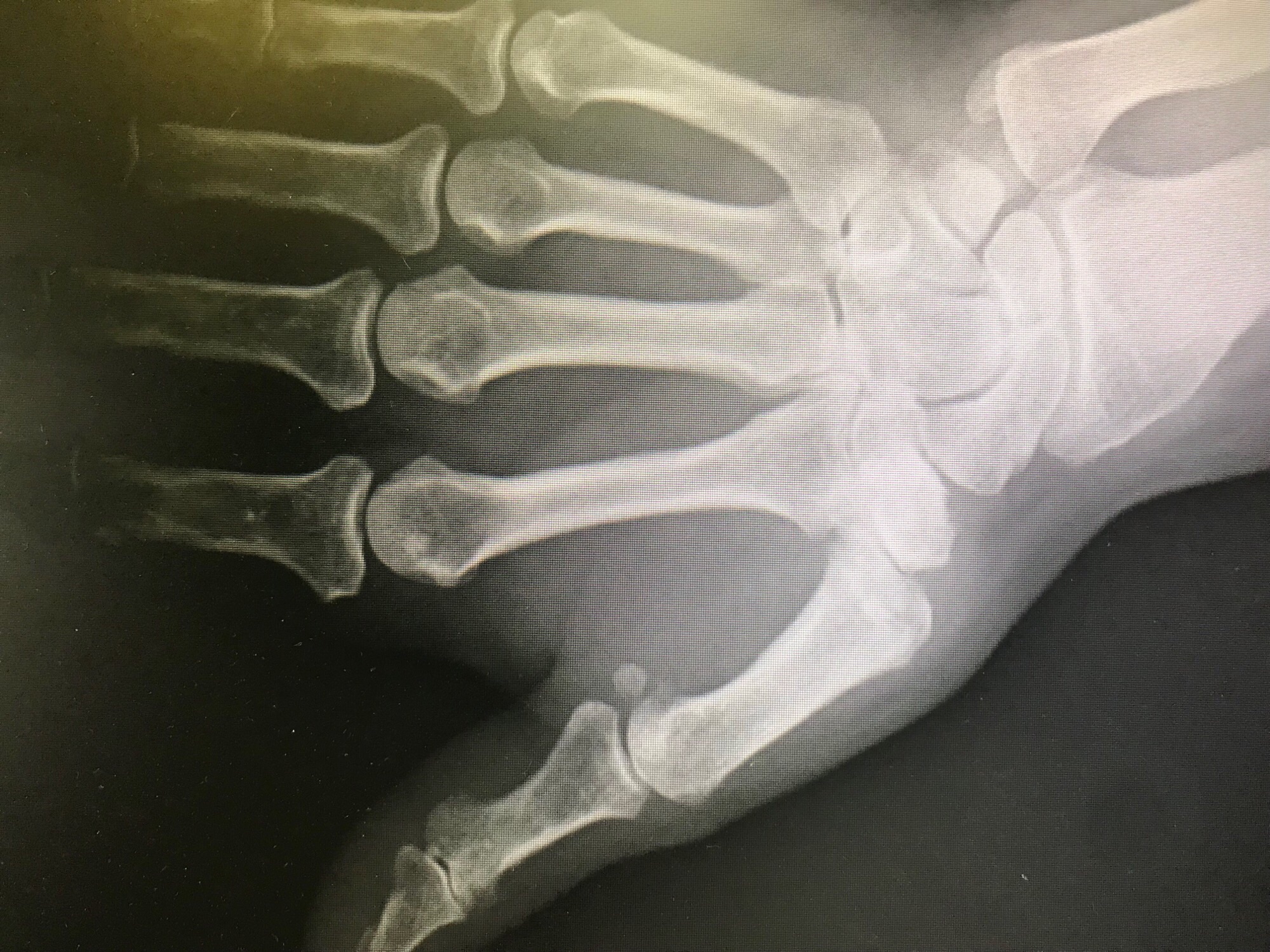 Rizartrosis o artrosis del pulgar - Signos radiológicos